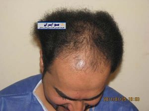 نمونه ارسال عکس برای کاشت مو سر کمی خم