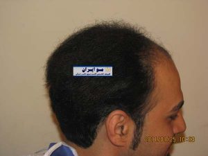 نمونه ارسال عکس برای کاشت مو نمای نیمرخ راست