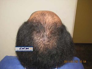 نمونه ارسال عکس برای کاشت مو نمای بالا